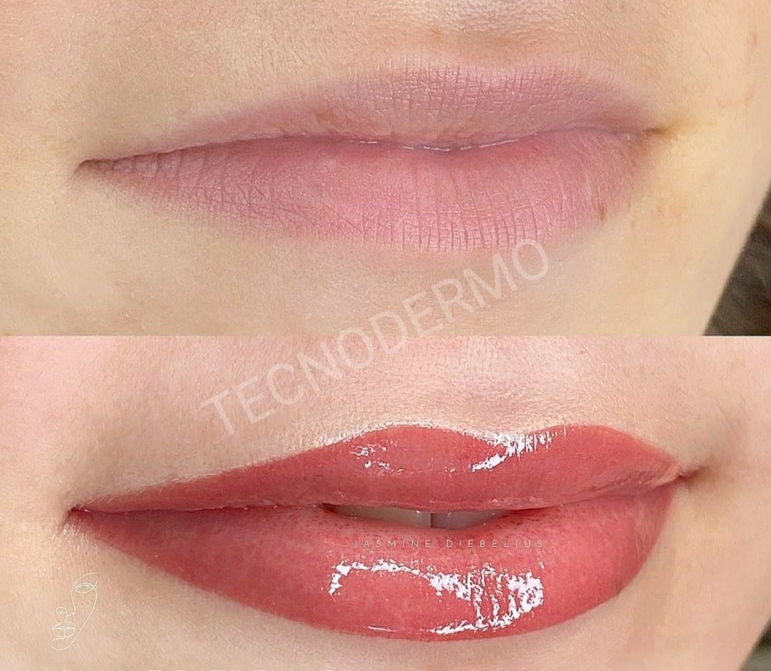 labios-tecnodermo